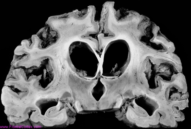 Laminar Necrosis, internal carotid circulations, bilateral